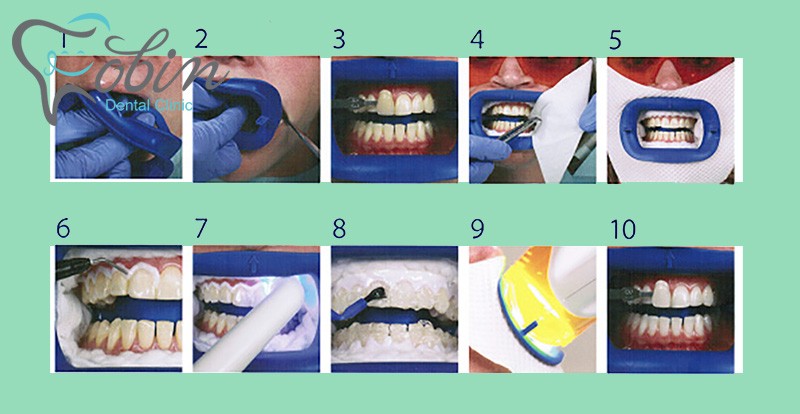 مراحل انجام خدمات بلیچینگ دندان